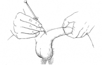 penile-injection-step10.jpg