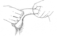 penile-injection-step9.jpg